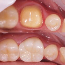 Зубной мост или имплант — что лучше?